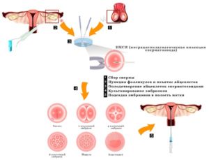 Не оплодотворяются яйцеклетки ЭКО+ИКСИ в чем причина?
