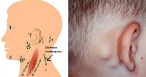 Восполены лимфоузлы на голове у ребенка 2 года