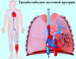 Эмболия легочной артерии