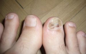 Боль под ногтем большого пальца ноги