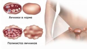 Поликистоз яичников: симптомы, лечение