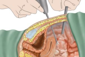 Лапароскопическая операция и эндометриоз