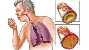 Кашель с мокротой и одышка