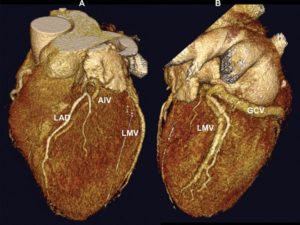 Компьютерная томография (КТ) сердца