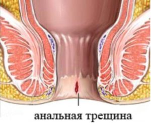 Боль в заднем проходе у ребенка