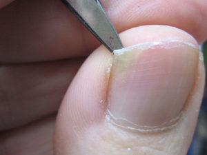 Боль под ногтем большого пальца ноги