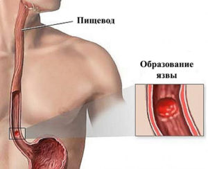 Симптомы болезни - боли в пищеводе