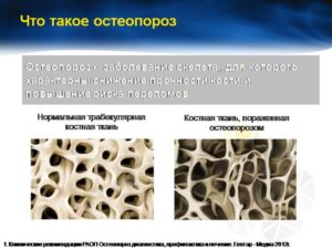 Что такое остеопороз? Что вам необходимо знать