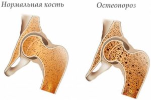 Что такое остеопороз? Что вам необходимо знать