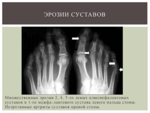 Профилактика эрозии суставов при ревматоидном артрите