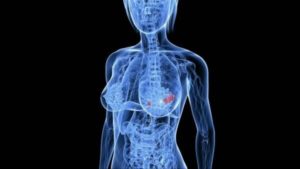 Рак груди и остеопороз