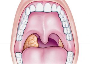 хронический тонзиллит