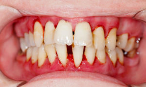Симптомы болезни - зубные боли