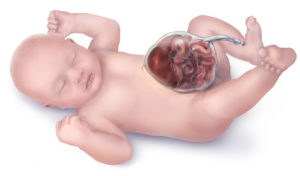 физиологическая эмбриональная кишечная грыжа