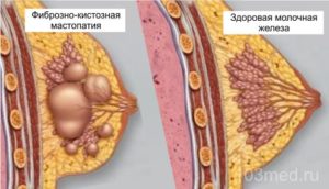 Фиброзно-кистозная трансформация лёгких