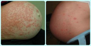 Заболевания кожи во время беременности