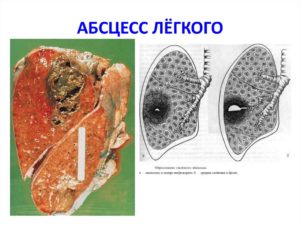 Абсцесс легкого