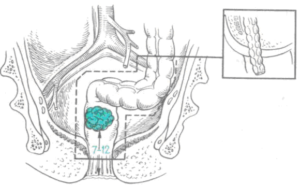Пластика прямой кишки