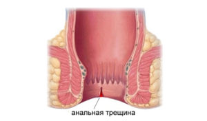 Растяжение анального кольца