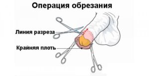 сколько стоит обрезание крайней плоти в Украине