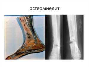 Пятнистый посттравматический остеопороз и другие осложнения