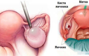 нет ответа яичников на стимуляцию (эко)