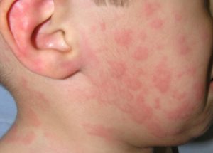 аллергия и запоры