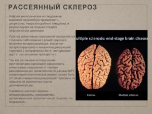 Романтические отношения и рассеянный склероз