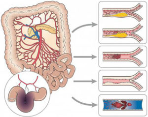 Ишемия кишечника