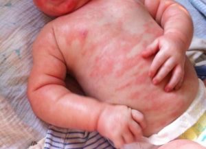 Аллергия у 8-месячного ребенка