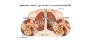 Хронические обструктивные болезни легких