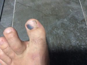 синеют пальцы ног