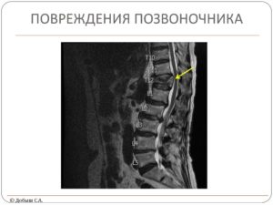 Повреждения позвоночника