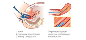 Тонус матки после переноса эмбрионов