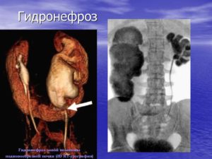 каликопиелоуретероэктазия правой почки