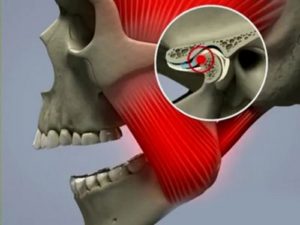 не могу полностью открыть рот и боль в челюсти