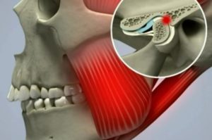 Симптомы болезни - боли в челюсти