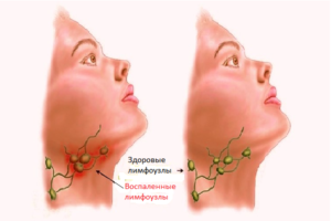 Красное горло и увеличены лимфоузлы.