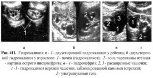 гидрокаликоз при беременности