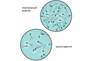 беременность при азооспермии