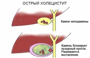 Острый холецистит