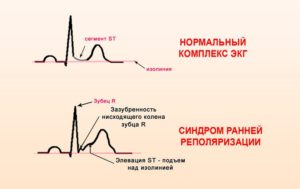 Симптомы болезни - нарушенияпроцессов реполяризации желудочков