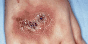 Грибковые заболевания легких (микозы)