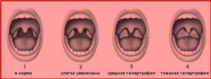 Гипертрофия носоглоточной миндалины (аденоиды)