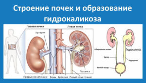 гидрокаликоз при беременности