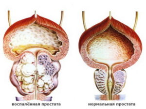 Можно ли делать массаж предстательной железы при кальцинатах