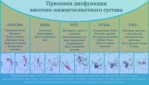 Дисфункция височно-нижнечелюстного сустава