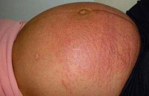 Заболевания кожи во время беременности