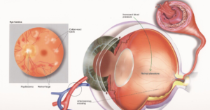 Гипертония: Высокое артериальное давление и заболевание глаз