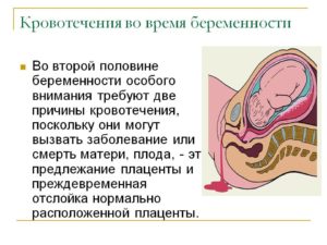 Кровотечения во время беременности